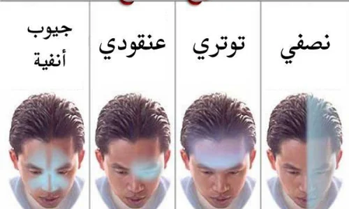 الصداع النصفي