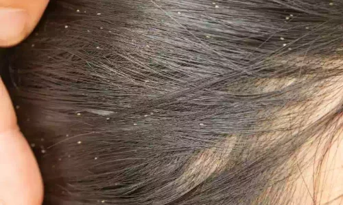 تعرف على الحلم بقملة في الشعر في المنام لابن سيرين