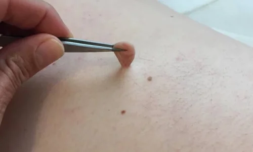 تأويلات ابن سيرين لتفسير رؤية الزوائد الجلدية في المنام