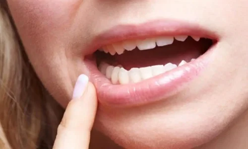 تفسير رؤية الضرس الاسود في المنام لابن سيرين