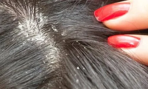 ما أبرز تأويلات رؤية القمل الأبيض في المنام للمطلقة لابن سيرين وكبار العلماء؟