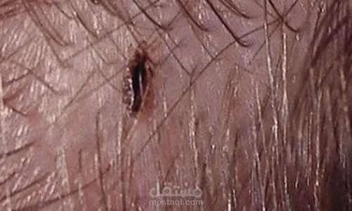 تفسير رؤية القمل في المنام للعزباء لابن سيرين