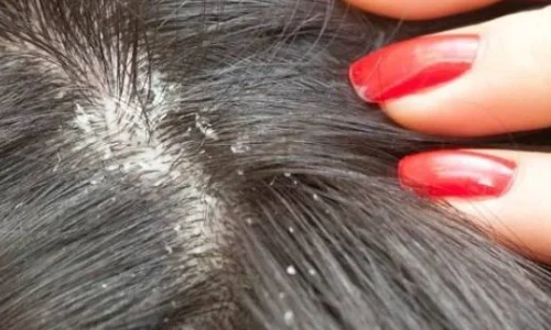 أهم 100 تفسير لرؤية القمل في راس ابني في المنام لابن سيرين