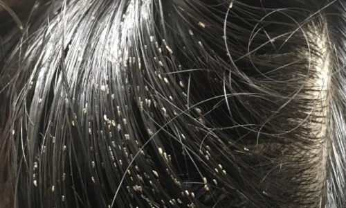 أهم تفسيرات رؤية القمل الصغير في الحلم لابن سيرين