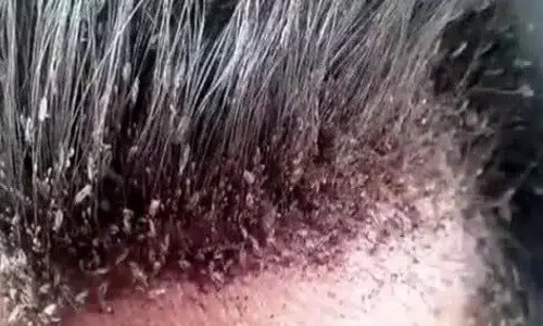 ما هو تفسير رؤية القمل في المنام للرجل المتزوج لابن سيرين؟
