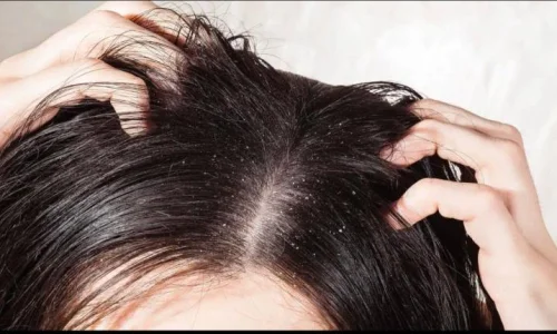 أهم تفسيرات رؤية القمل في شعر الميت في المنام لابن سيرين