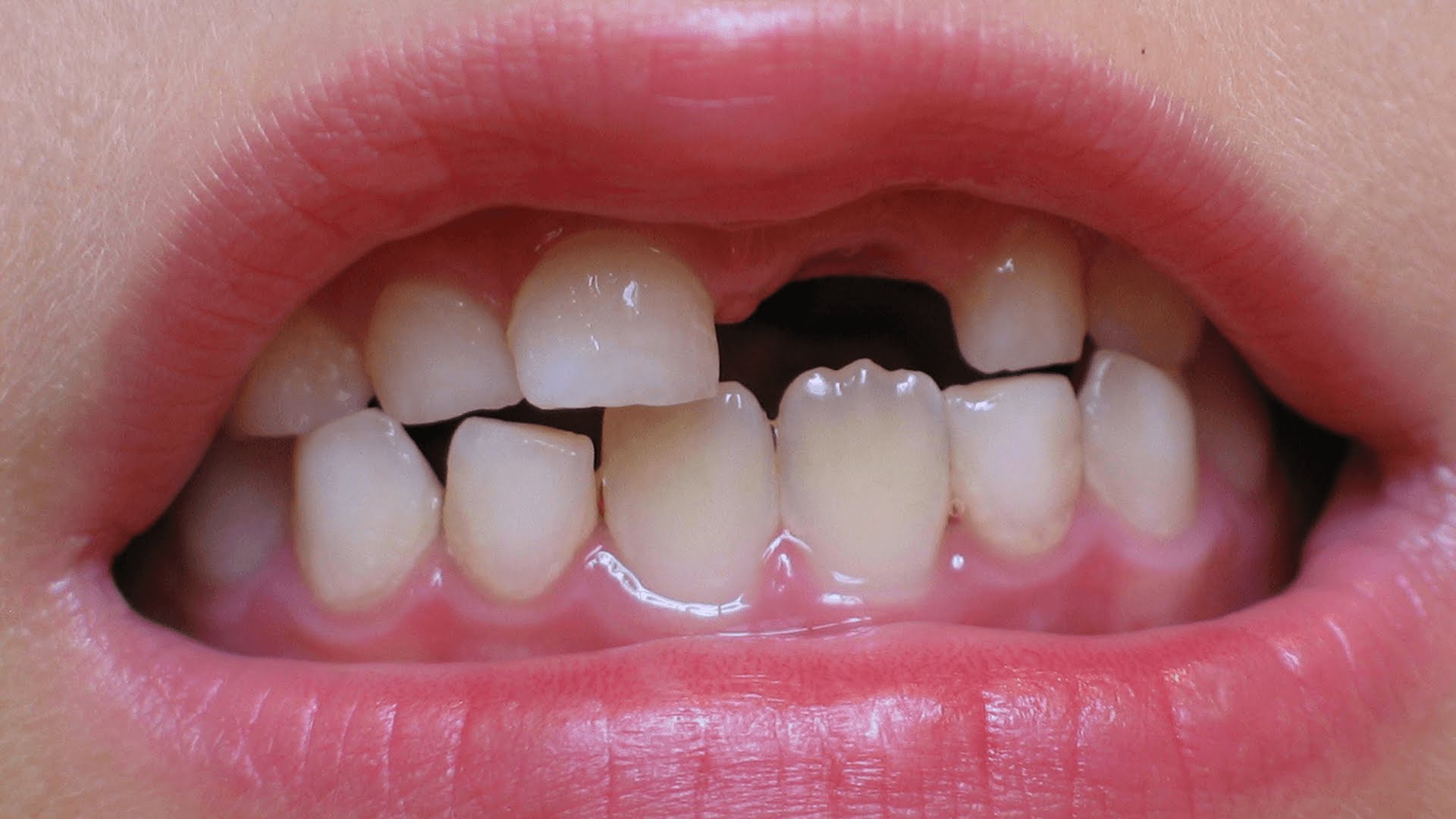 تعرف على تفسير حلم تكسير الاسنان لابن سيرين