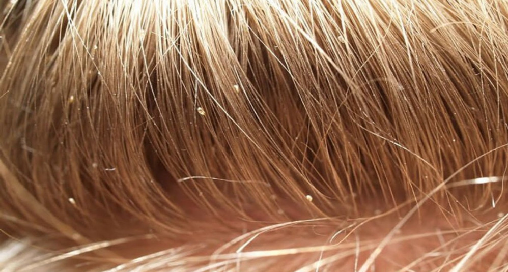 تفسير حلم القمل الأسود في الشعر للمتزوجة لابن سيرين