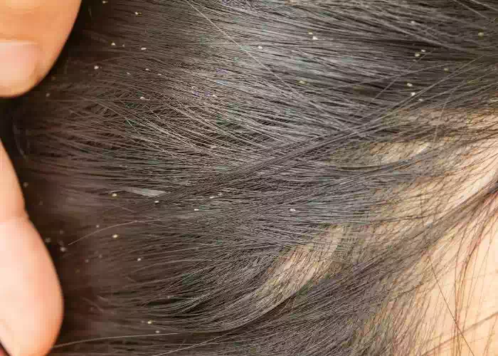 ما تفسير حلم القمل في شعري لابن سيرين؟