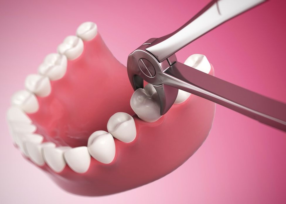 تفسير حلم خلع الضرس