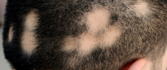 تفسير حلم فراغات في الشعر وما هو تفسير رؤية تساقط الشعر في المنام؟