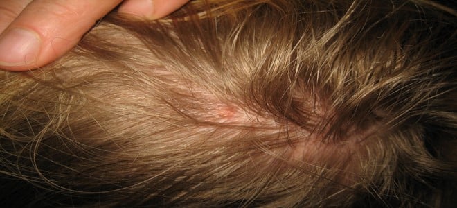 قتل القمل في المنام