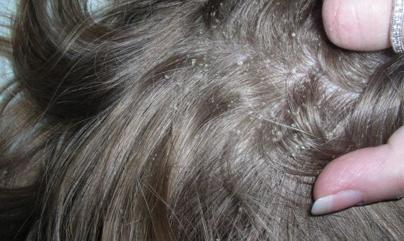 تفسير رؤية القمل في شعر شخص آخر في المنام