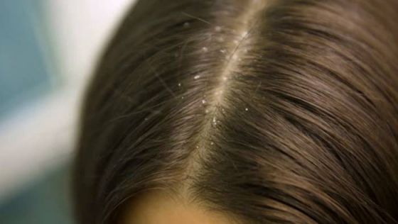 تعرف أكثر حول تفسير حلم القمل ف الشعر لابن سيرين