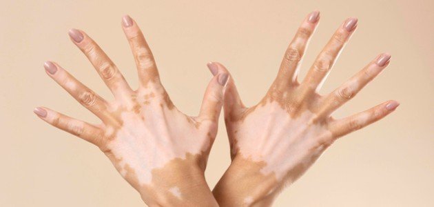 تأويلات ابن سيرين لرؤية البهاق في المنام