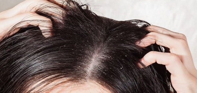 تفسير حلم قمل في شعر بنتي لابن سيرين