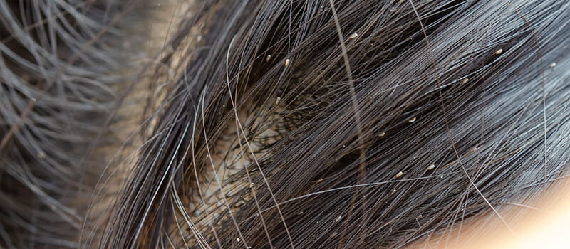 تفسير رؤية القمل في شعري