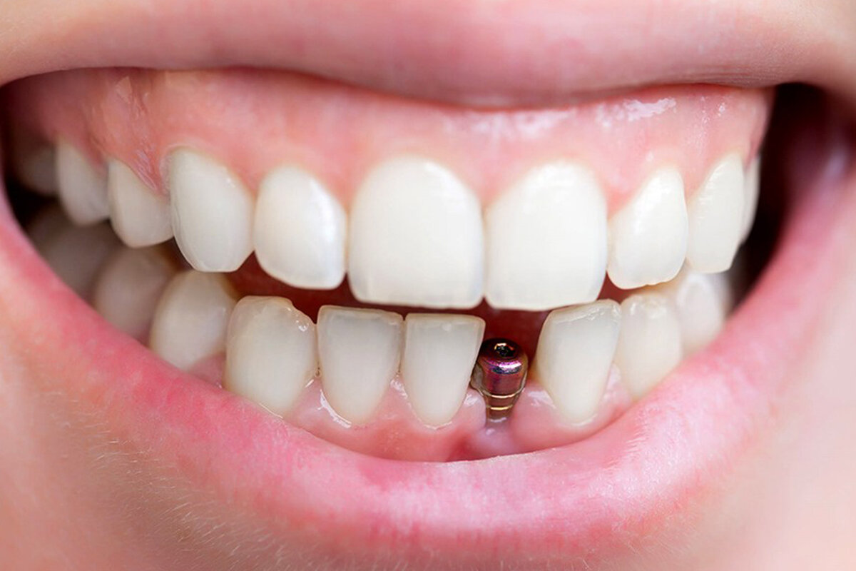 تفسير حلمت أن أسناني التركيب طاحت لابن سيرين