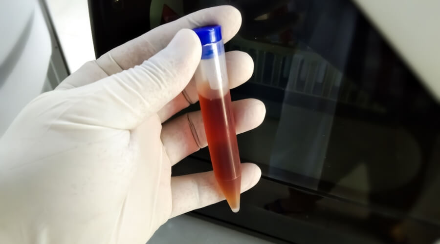 تفسير تبول الدم في المنام لابن سيرين