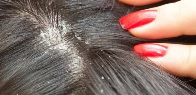 ما تفسير حلم القمل في المنام لابن سيرين؟